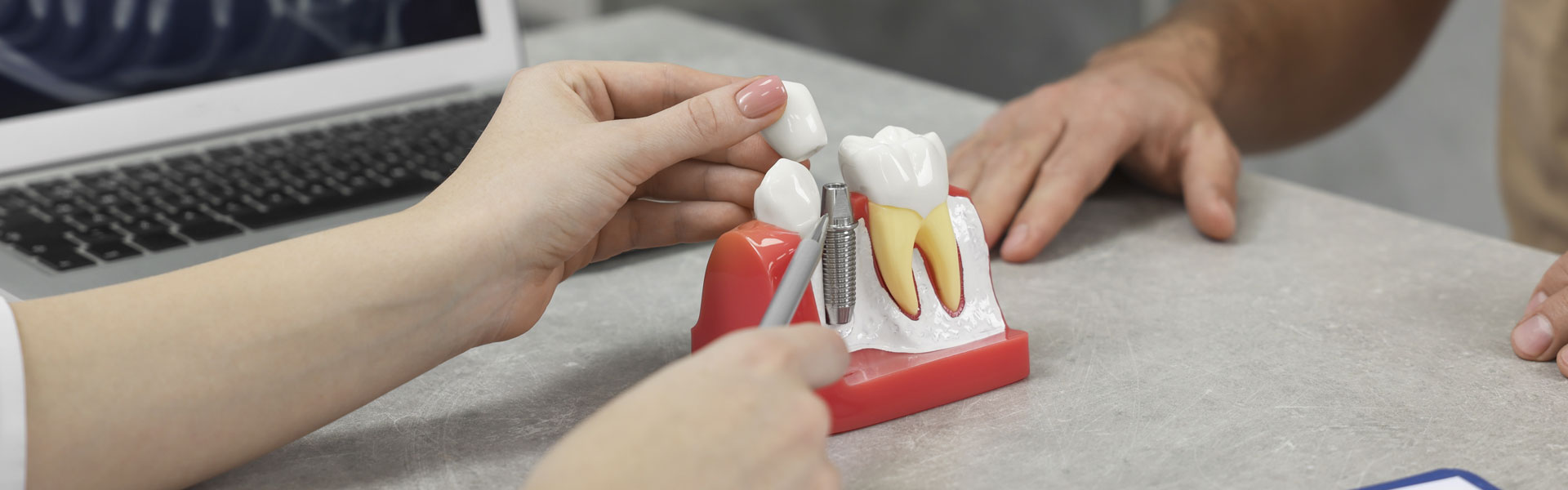 5 Ways to Maintain Your New Dental Implants in Winter