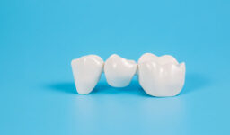 Why Dental Bridges May Be the Best Option for Your Missing Teeth?