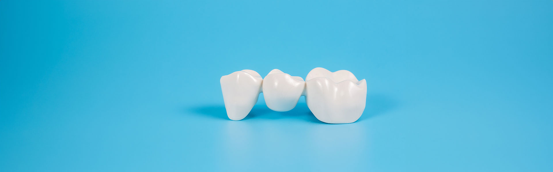 Why Dental Bridges May Be the Best Option for Your Missing Teeth?