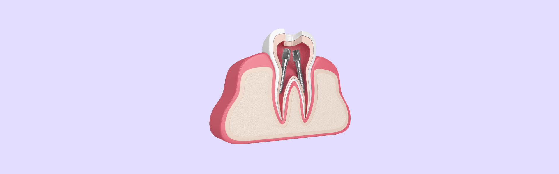 Can Root Canal Therapy Save Your Tooth and Relieve Pain?