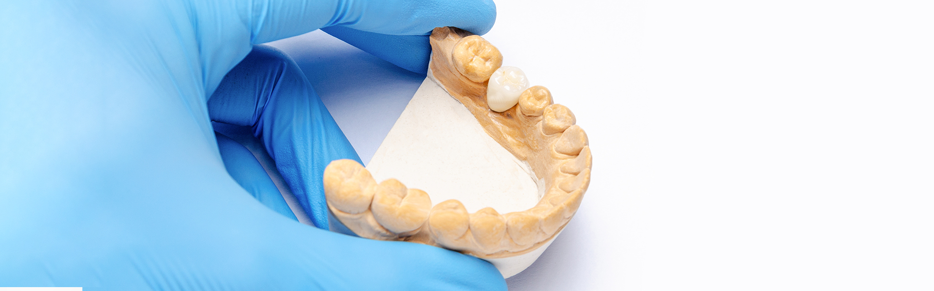 Factors to Think Of When Choosing a Dental Crown