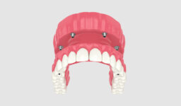 Are Full Mouth Dental Implants Worth It? Pros, Cons, and Alternatives
