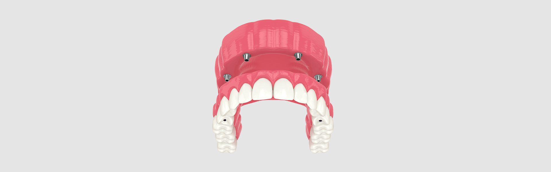 Are Full Mouth Dental Implants Worth It? Pros, Cons, and Alternatives