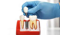 Why Dental Implants Are the Best Option for Tooth Replacement