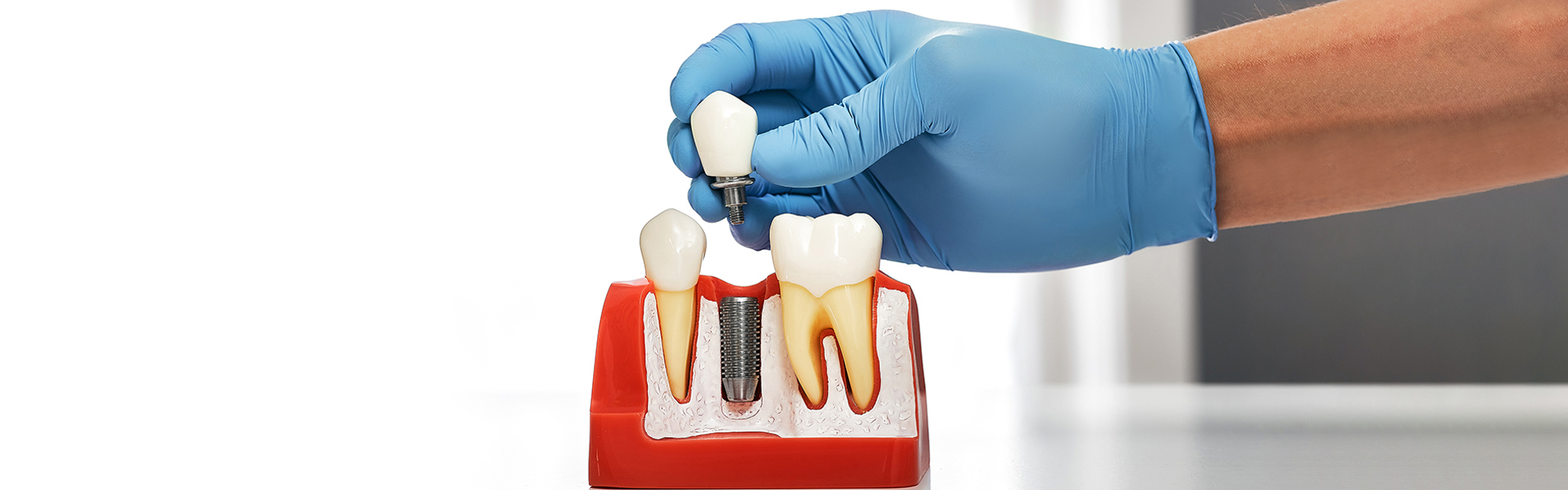 Why Dental Implants Are the Best Option for Tooth Replacement