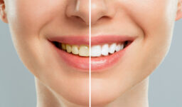 What Should You Expect from a Teeth Whitening Treatment?