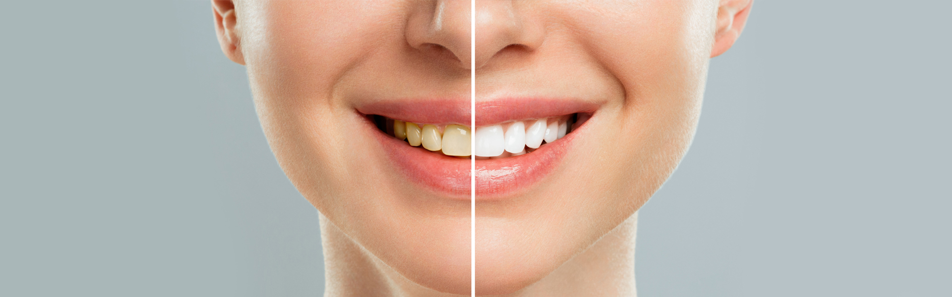 What Should You Expect from a Teeth Whitening Treatment?