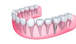 7 Reasons Dentists Recommend Dental Implants for Patients