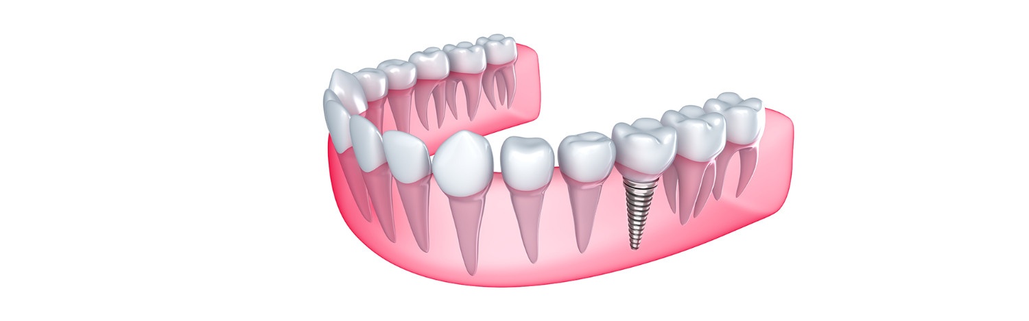 7 Reasons Dentists Recommend Dental Implants for Patients